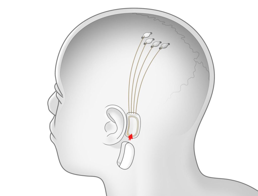Elon Musk’s Neuralink Will Launch Trials in Humans. But Scientists Are Concerned 27 – elon-musk-brain-chip-1