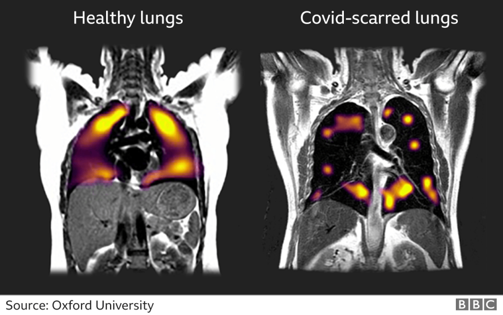 Long COVID: Hidden Damage in the Lungs Could Be Detected With This New Scanning Technique 27 – Long COVID: Hidden Damage in the Lungs Could Be Detected With This New Scanning Technique 14