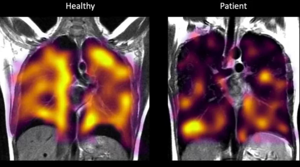Long COVID: Hidden Damage in the Lungs Could Be Detected With This New Scanning Technique 26 – long-covid-3446346